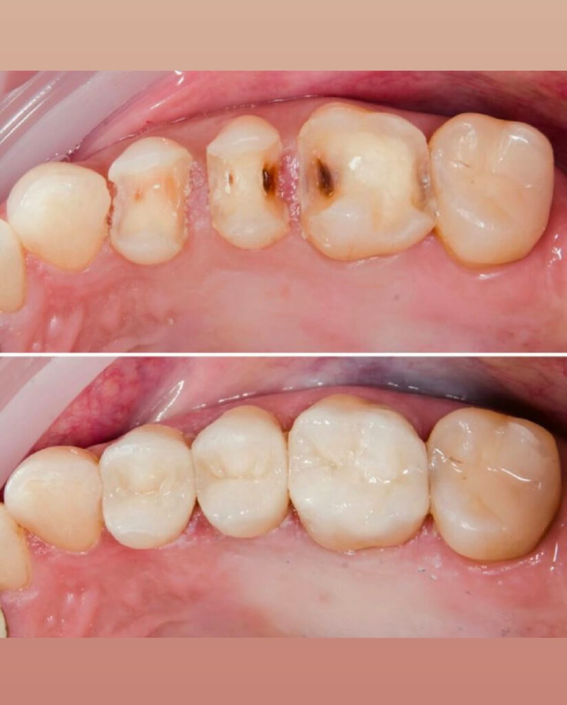 como es una tapadura dental antes y despues