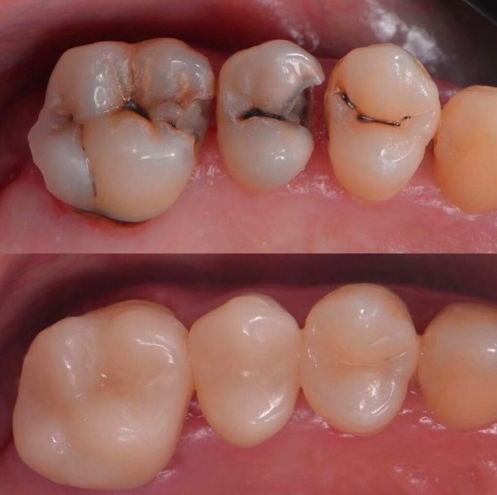 antes y despues de tapadura dental