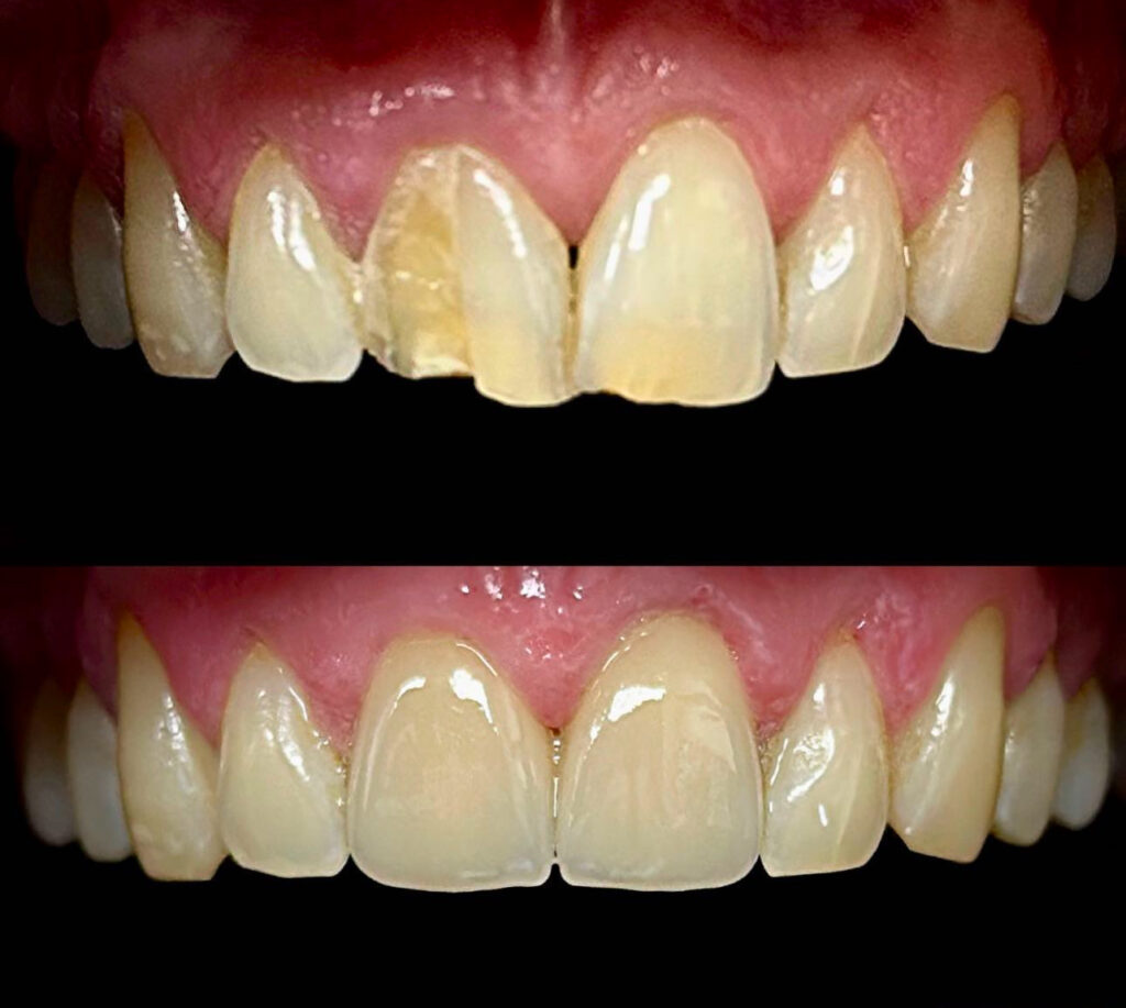 fundas dentales precio en chile
