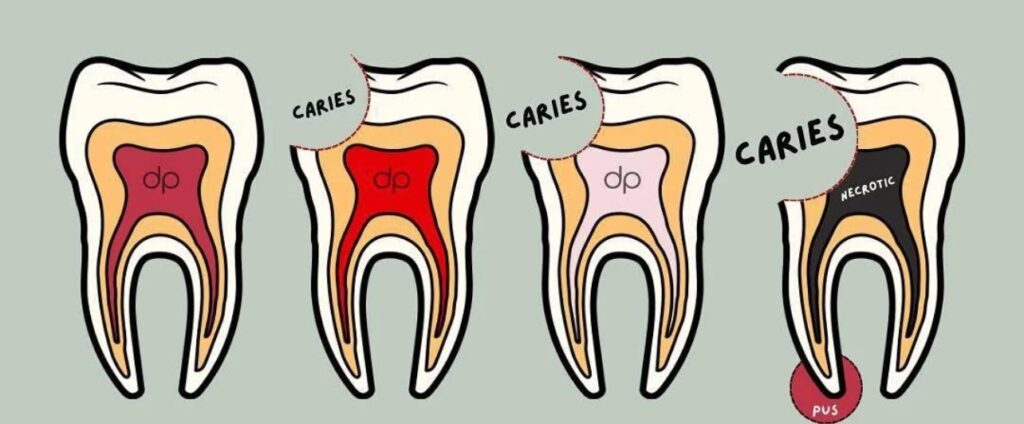caries dental avanzada para después ser tratada por endodoncia