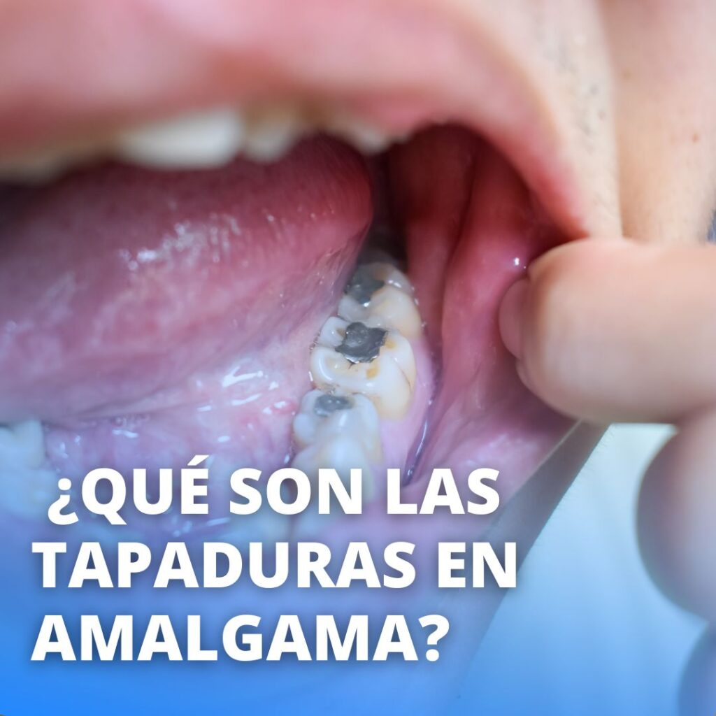 tapadura de amalgama